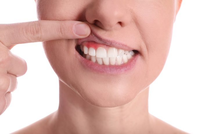 gingivitis en Las Palmas